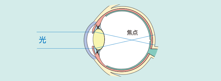 軸性近視（多くの強度近視）の画像