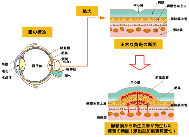 加齢黄斑(かれいおうはん)変性の説明画像