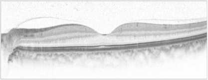 正常な眼の黄斑像