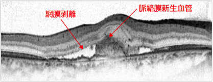 滲出型加齢黄斑(かれいおうはん)変性症の黄斑像