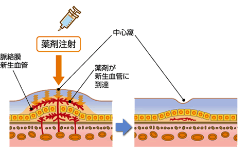 VEGF阻害剤による治療イメージ