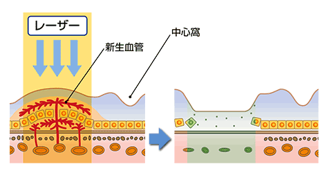 レーザー光凝固術イメージ
