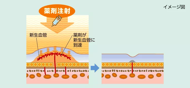 VEGF阻害剤による治療の画像
