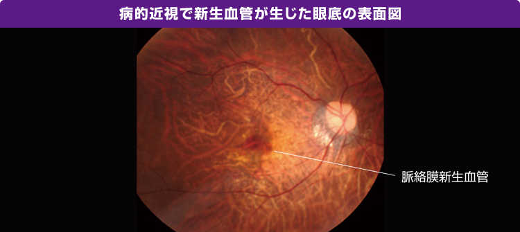 病的近視で新生血管が生じた眼底の表面図の画像