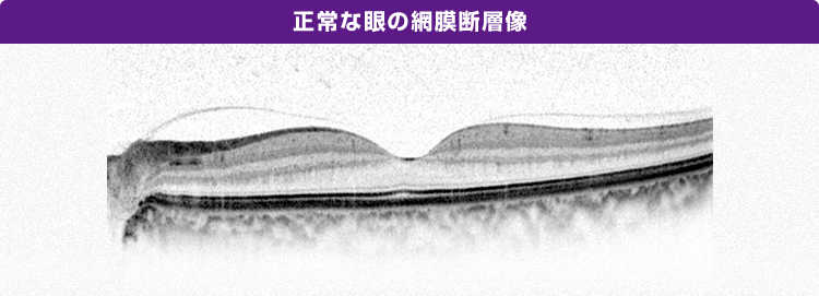 正常な眼の網膜断層像の画像