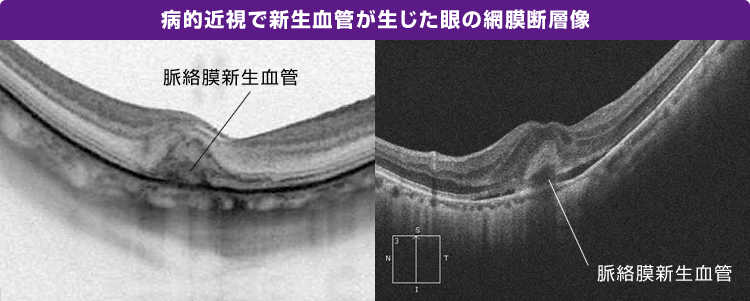 病的近視で新生血管が生じた眼の網膜断層像の画像