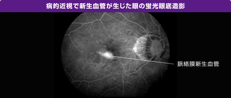 病的近視で新生血管が生じた眼の蛍光眼底造影の画像