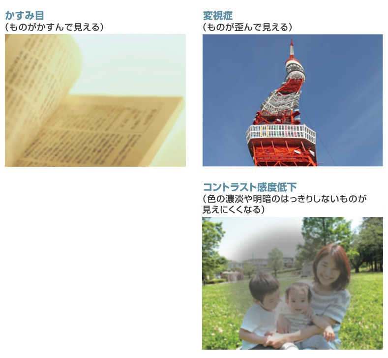 糖尿病黄斑浮腫の自覚症状(かすみ目、変視症、コントラスト感度低下)