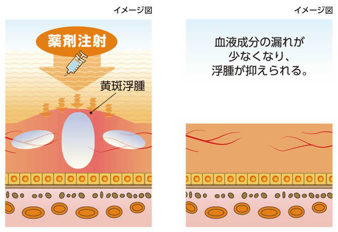 VEGF阻害剤　眼内への注射（イメージ図）