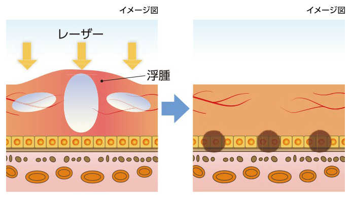 レーザー光を当てる治療の様子(イメージ図)