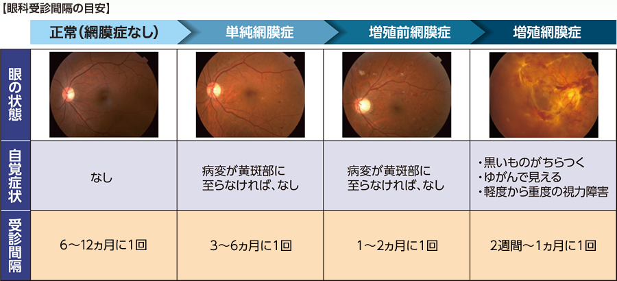 「眼科受信感覚の目安」 眼底が正常(網膜症なし)で自覚症状なしの場合は6〜12ヶ月に1回、単純網膜症(病変が黄斑部に至らなければ自覚症状はなし)の場合は3~6ヶ月に1回、増殖前網膜症(病変が黄斑部に至らなければ自覚症状はなし)の場合は1~2ヶ月に1回、増殖網膜症でかすみ眼・偏視症・視力低下・失明の自覚症状がある場合は2週間~1ヶ月に1回