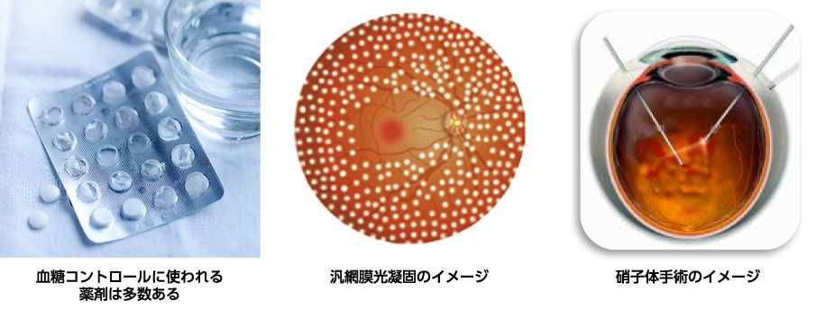 血糖コントロールに使われる薬剤は多数あるイメージ図、汎網膜光凝固のイメージ図、硝子体手術のイメージ図