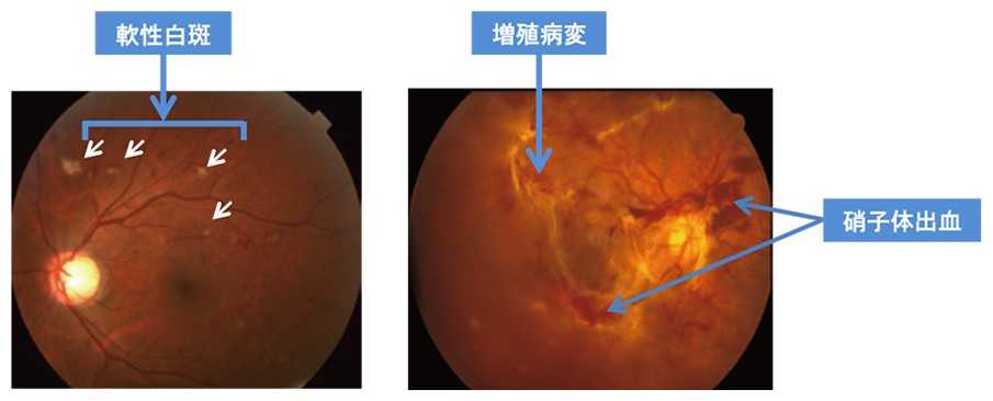 神経線維層の局所貧血である軟性白斑の様子、硝子体内にできた増殖病変と硝子体出血の様子
