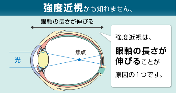 もしかするとそれは、強度近視の悪化かもしれません。病気の悪化は、眼軸の長さが伸びることで起こります。