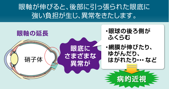 眼軸が伸びると、後部に引っ張られた眼底に強い負担が生じ、眼球の後ろ側がふくらむ、網膜が伸びる、網膜がゆがむ、網膜がはがれるなどの異常をきたします。