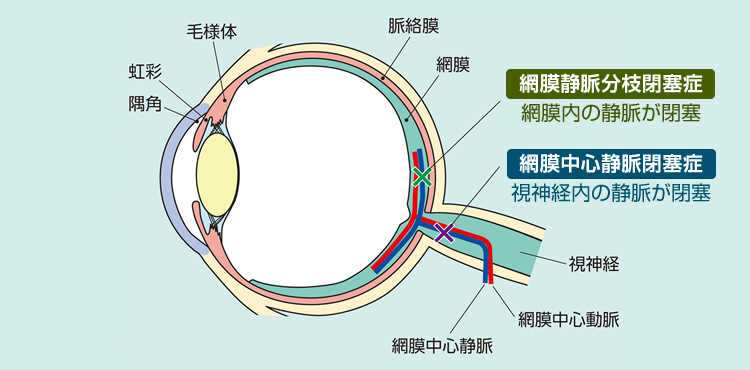 網膜静脈分枝閉塞症と網膜中心静脈閉塞症の違いを表した画像