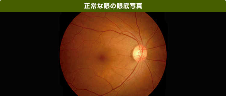 正常な眼の眼底写真の画像