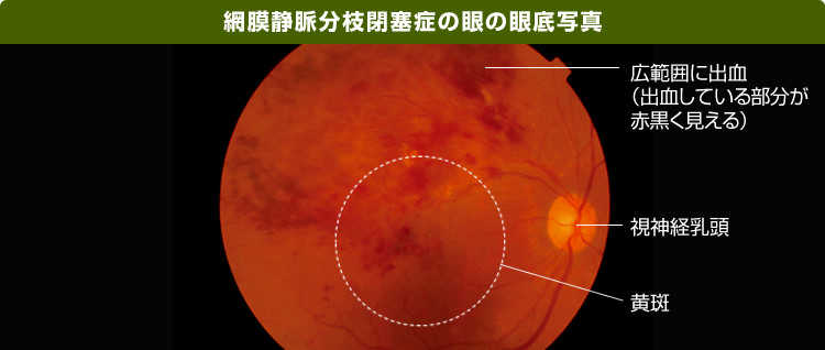 網膜静脈分枝閉塞症の眼の眼底写真の画像