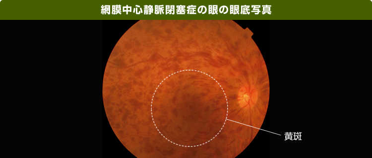 網膜中心静脈閉塞症の眼の眼底写真の画像