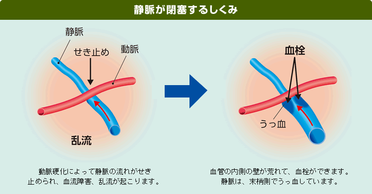 静脈が閉塞するしくみ