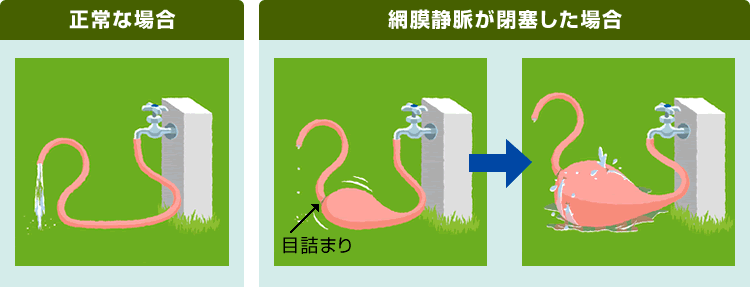網膜静脈閉塞症になった眼の状態