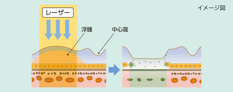 レーザー光凝固による治療の画像