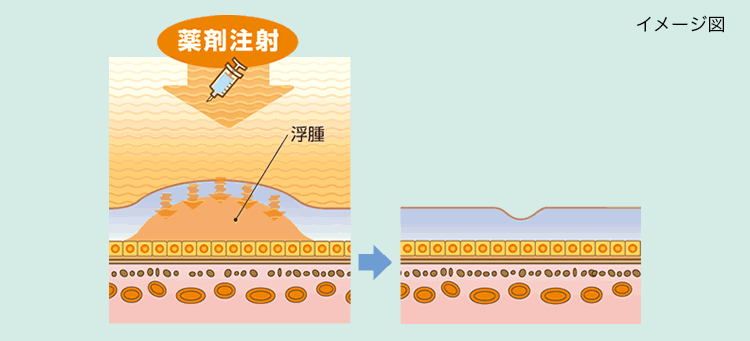VEGF阻害剤による治療の画像