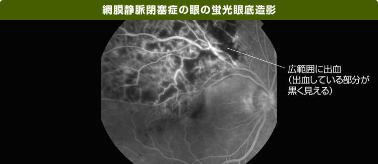 網膜静脈分枝閉塞症の眼の蛍光眼底造影の画像