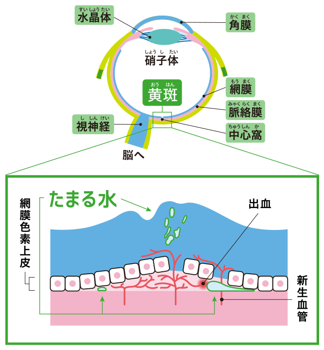 加齢黄斑変性の「たまる水」 | VISION 100 | 網膜ドットコム