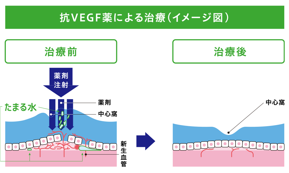 抗VEGF薬による治療(イメージ図)