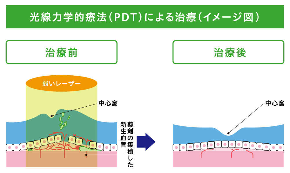 光線力学的療法(PDT)による治療(イメージ図)