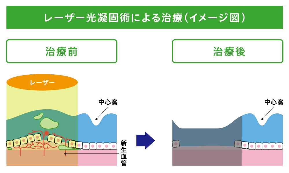 レーザー光凝固術による治療(イメージ図)