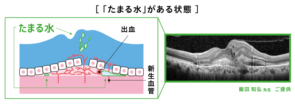 加齢黄斑変性の「たまる水」 | VISION 100 | 網膜ドットコム