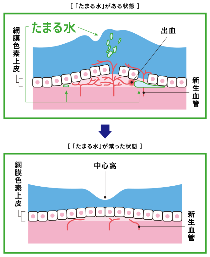 滲出型加齢黄班変性における「たまる水」の説明図