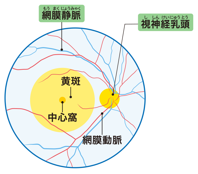加齢黄班変性のしくみの説明図