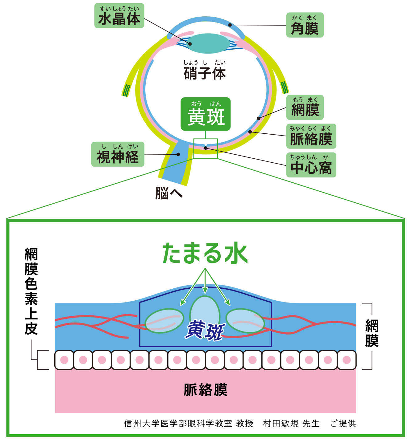 糖尿病黄斑浮腫における「たまる水」の説明図 信州大学医学部眼科学教室 教授 村田敏規 先生 ご提供