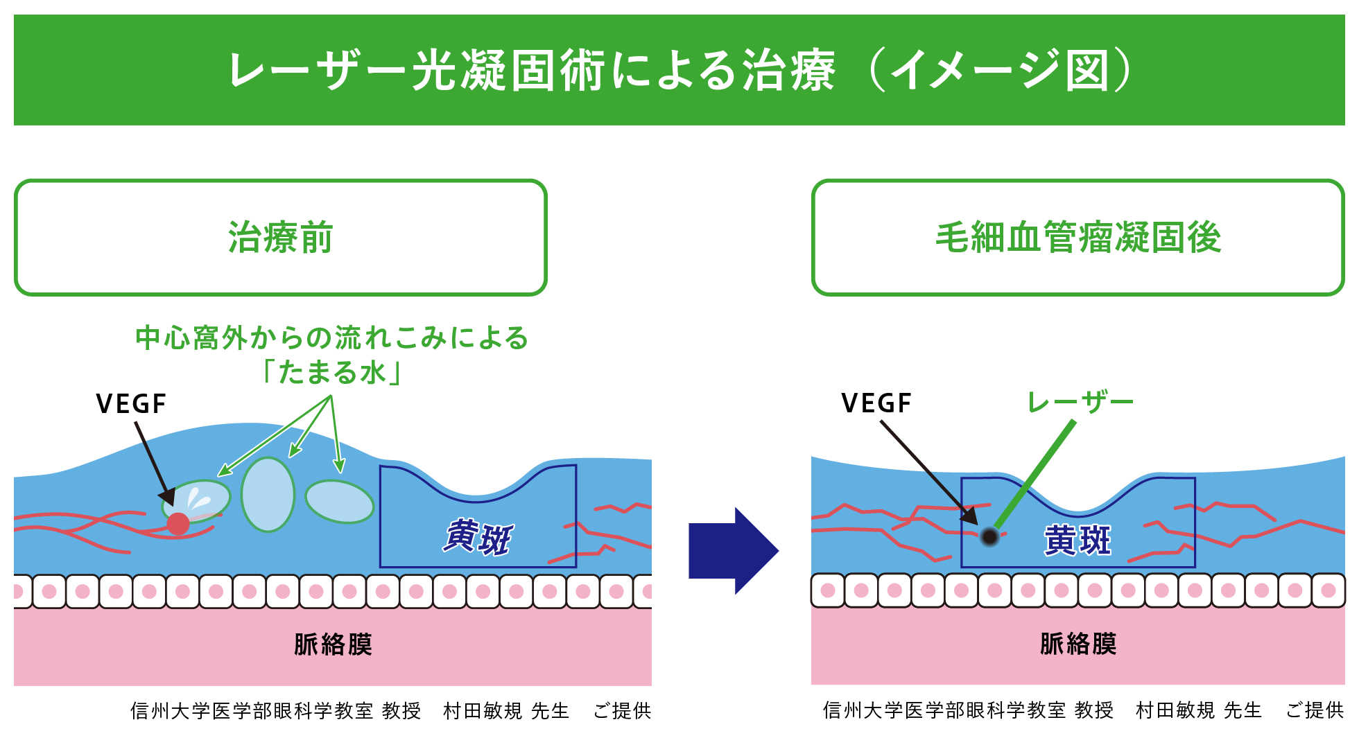 レーザー光凝固術による治療(イメージ図) 信州大学医学部眼科学教室 教授 村田敏規 先生 ご提供