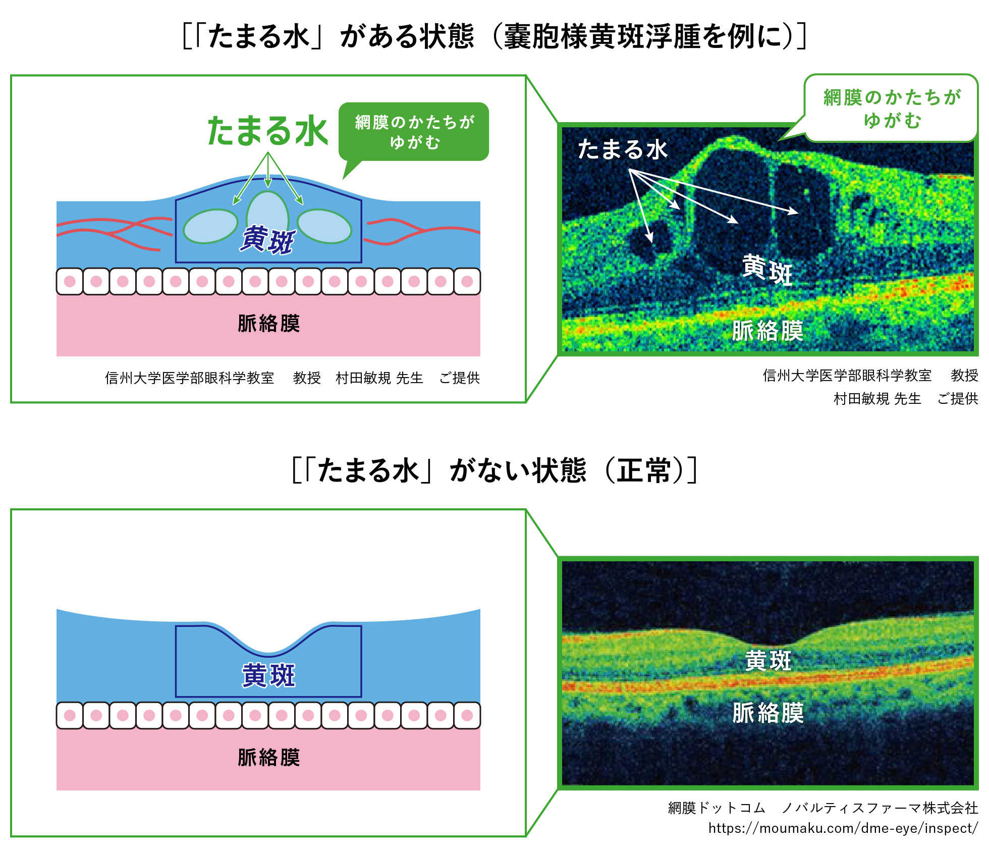 ［「たまる水」がある状態（嚢胞様黄斑浮腫を例に）］と［「たまる水」がない状態（正常）］のOCT検査写真 信州大学医学部眼科学教室 教授　村田敏規 先生　ご提供
