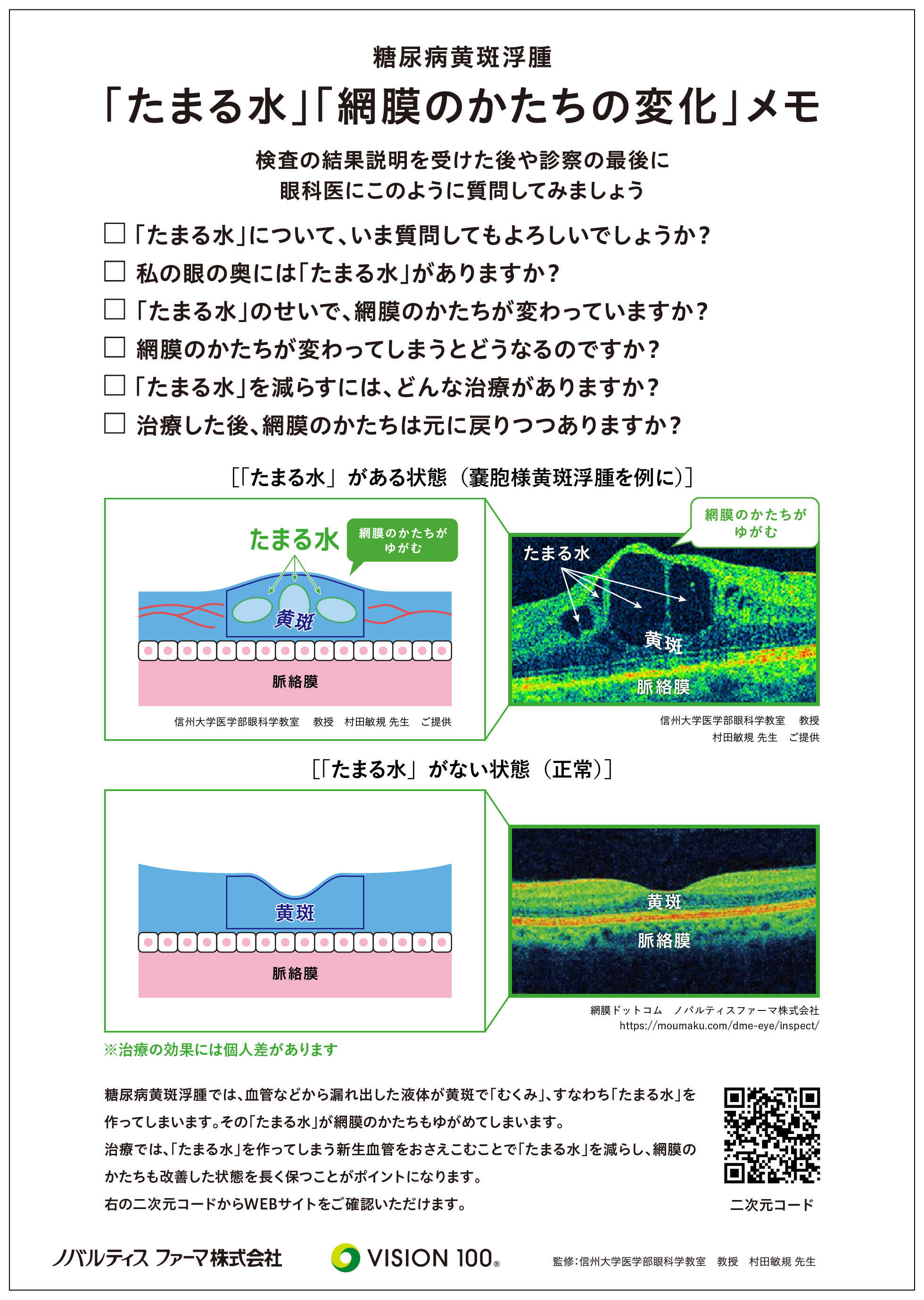 糖尿病黄斑浮腫「たまる水」「網膜のかたちの変化」メモ