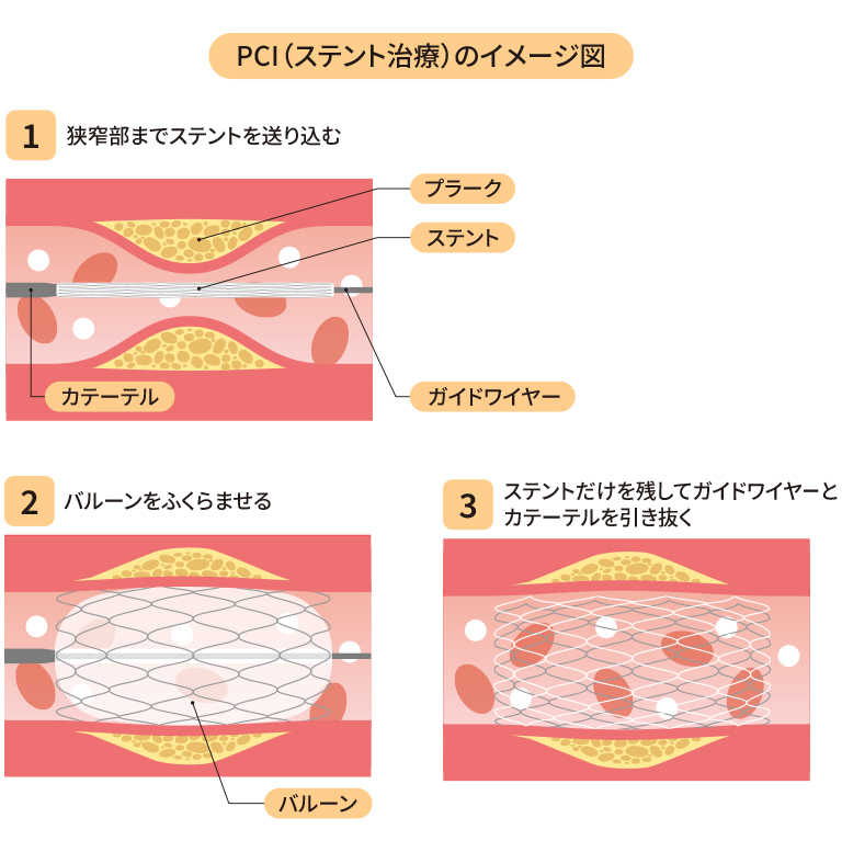 PCI（ステント治療）のイメージ図