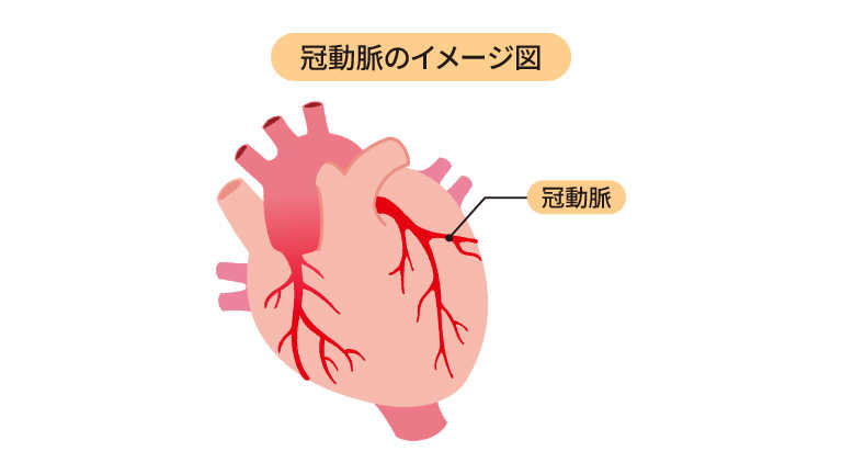 冠動脈のイメージ図