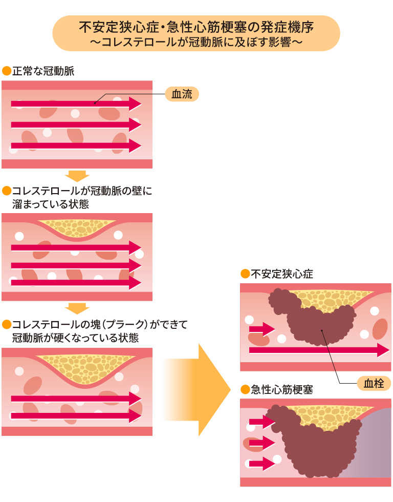 急性冠症候群（ACS）とはなんですか？ | コレステサポーター 