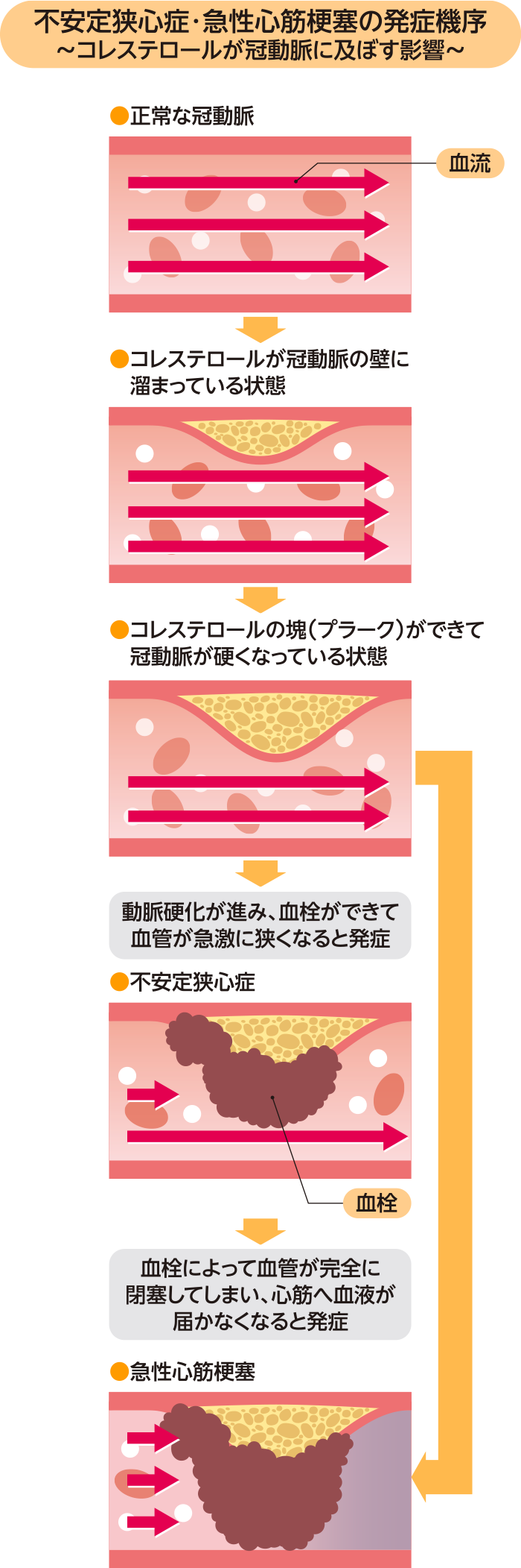 イメージ図:不安定狭心症・急性心筋梗塞の発症機序~コレステロールが冠動脈に及ぼす影響~
