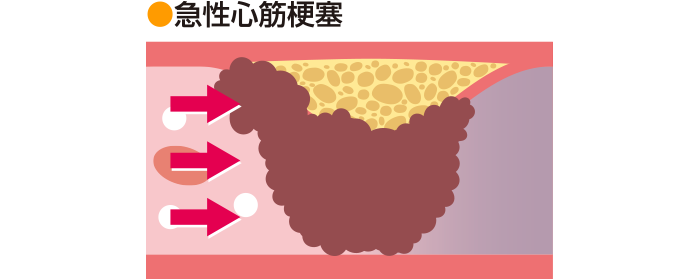 急性心筋梗塞