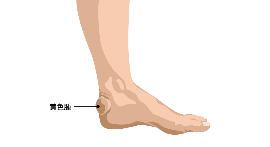 イラスト：家族性高コレステロール血症(FH)に見られる黄色腫