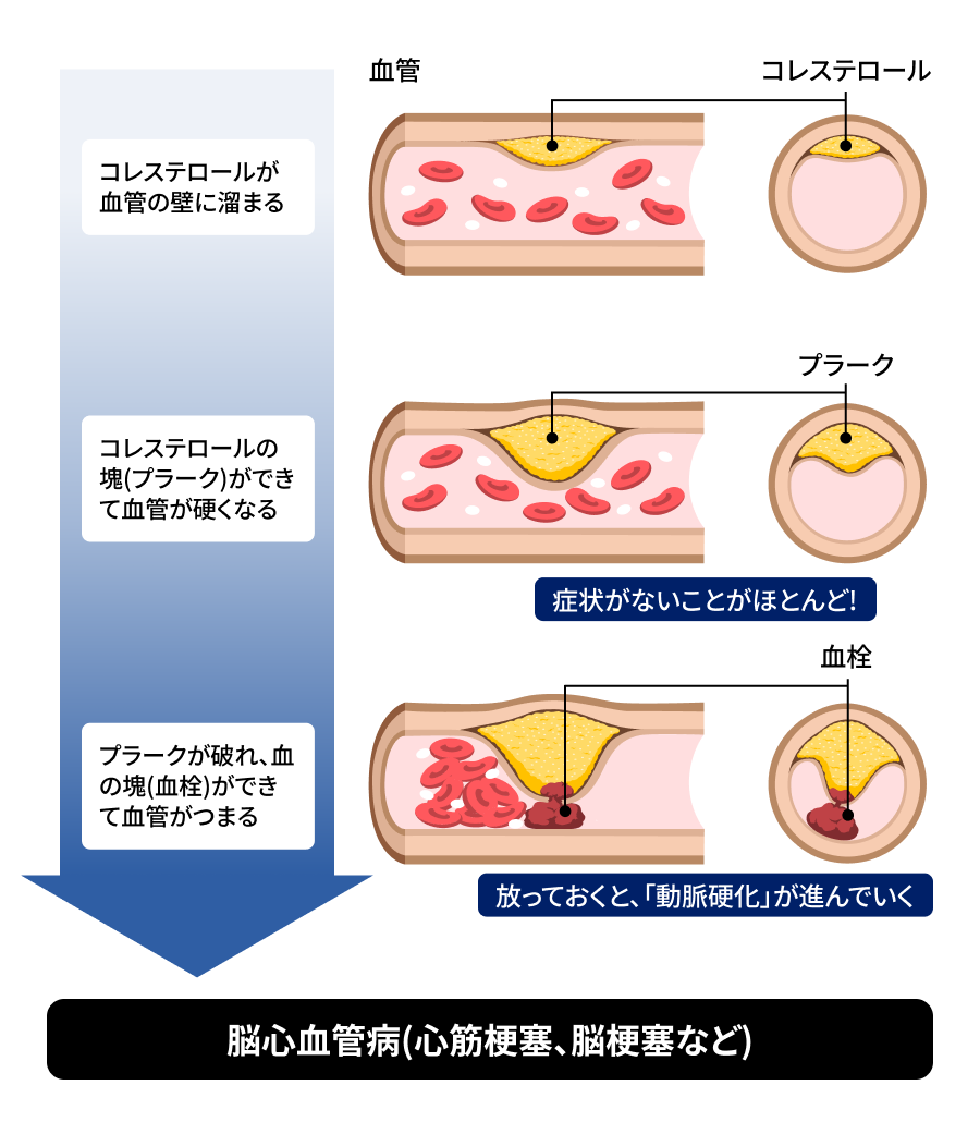 イメージ図：動脈硬化の進行によりプラークが破れ血栓ができて脳心血管病を引き起こす