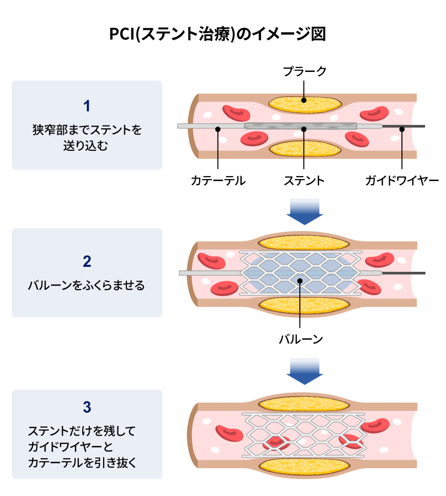 PCI（ステント治療）のイメージ図