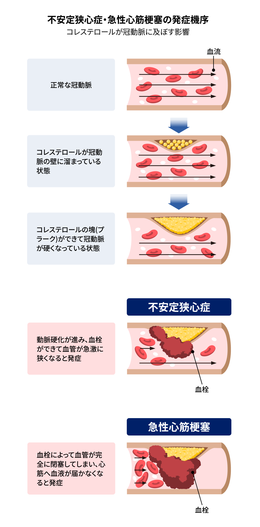 イメージ図：不安定狭心症・急性心筋梗塞の発症機序～コレステロールが冠動脈に及ぼす影響～