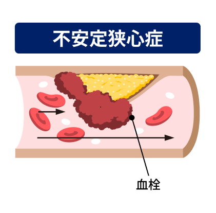 イラスト：不安定狭心症