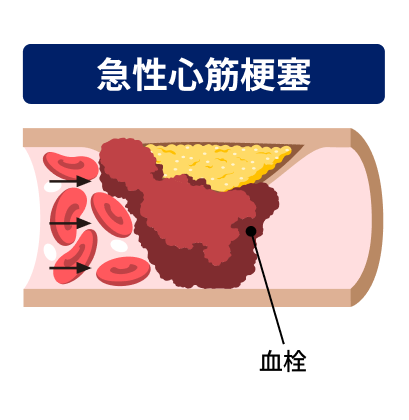 イラスト：急性心筋梗塞